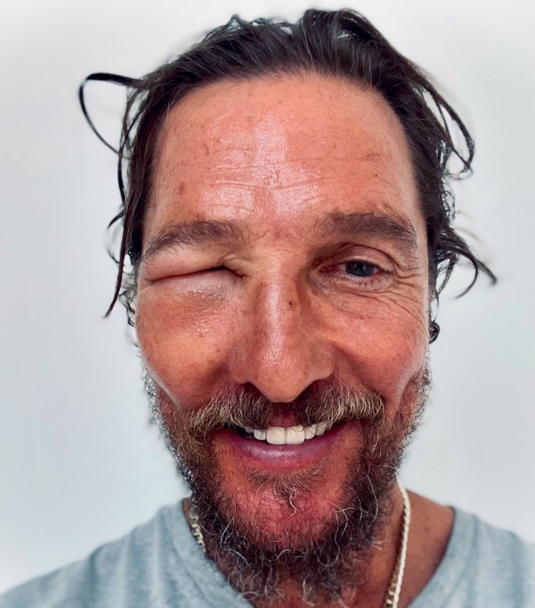 Matthew McConaughey compartilha selfie de olho inchados após a situra de abelha: 'Bee Swell'